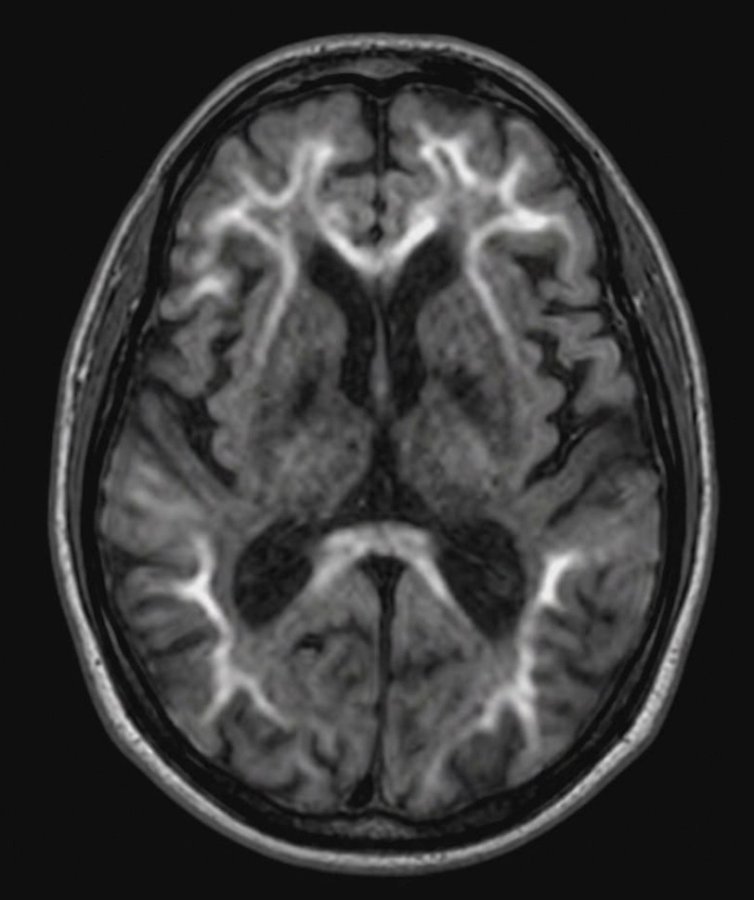 1150430-2-3-大腦皮髓質交界處對稱性高訊號曲線圖片由陳珮昀醫師提供.jpg