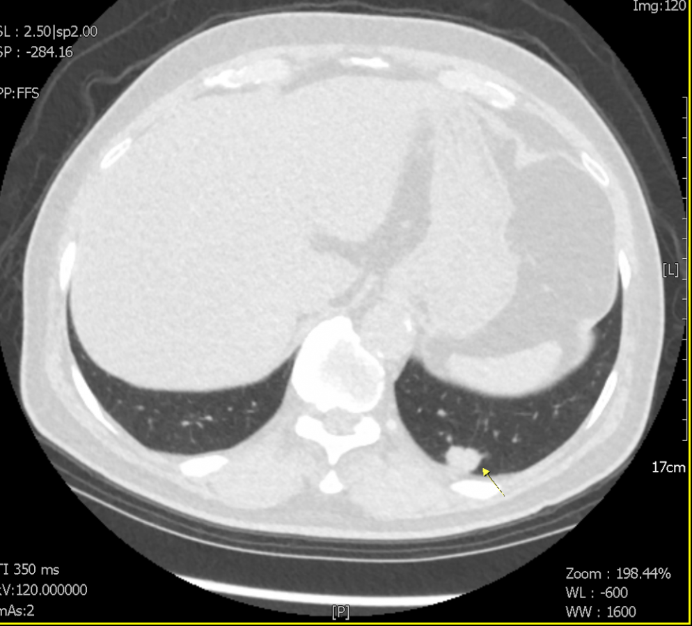 lung CT