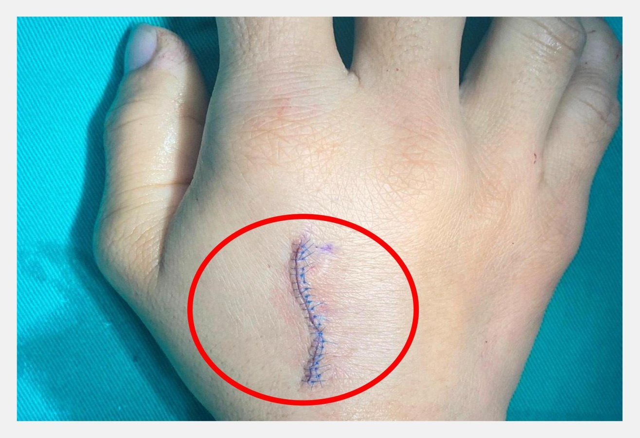 照片王思翰醫師為病患採用術後可盡早進行復健和活動的微創掌骨鋼板復位內固定