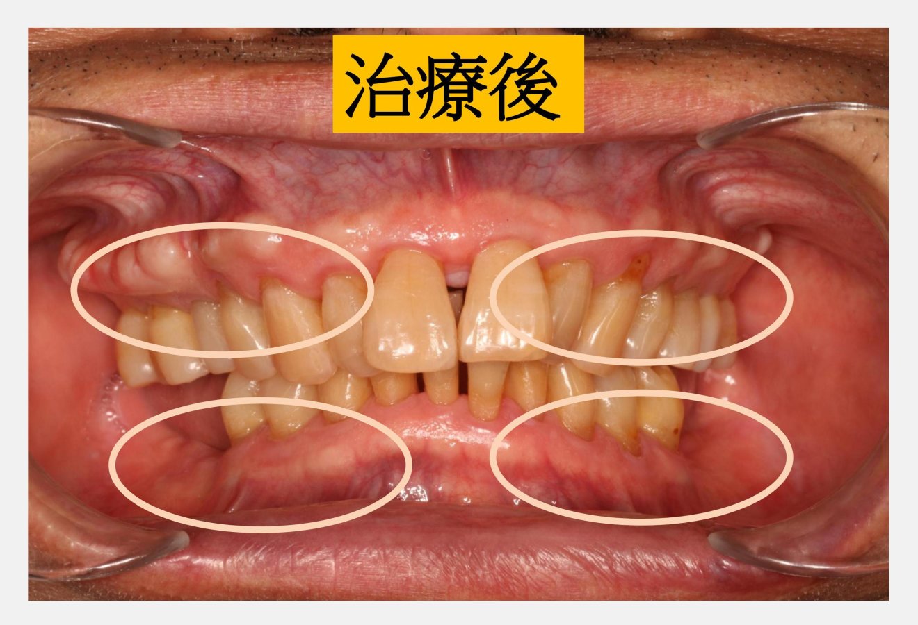 照片洪繹旻醫師治療後病患牙齦已恢復正常圓圈處治療後 2