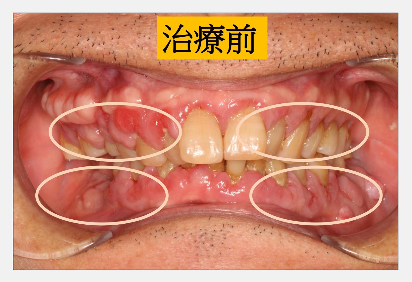 照片病患因全口牙齦腫脹圓圈處求診洪繹旻醫師診斷發現是高血壓用藥而造成