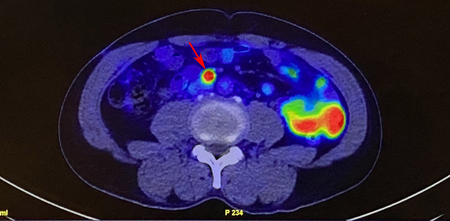 新一代PSMA正子掃描可提早並精準揪出病人攝護腺癌轉移箭頭指處 copy