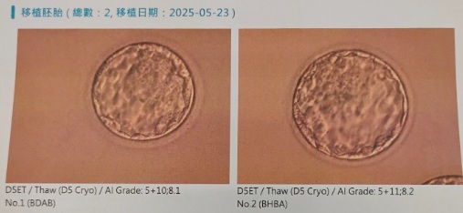 王小姐植入2顆特優等胚胎後產下1名男寶 2 0