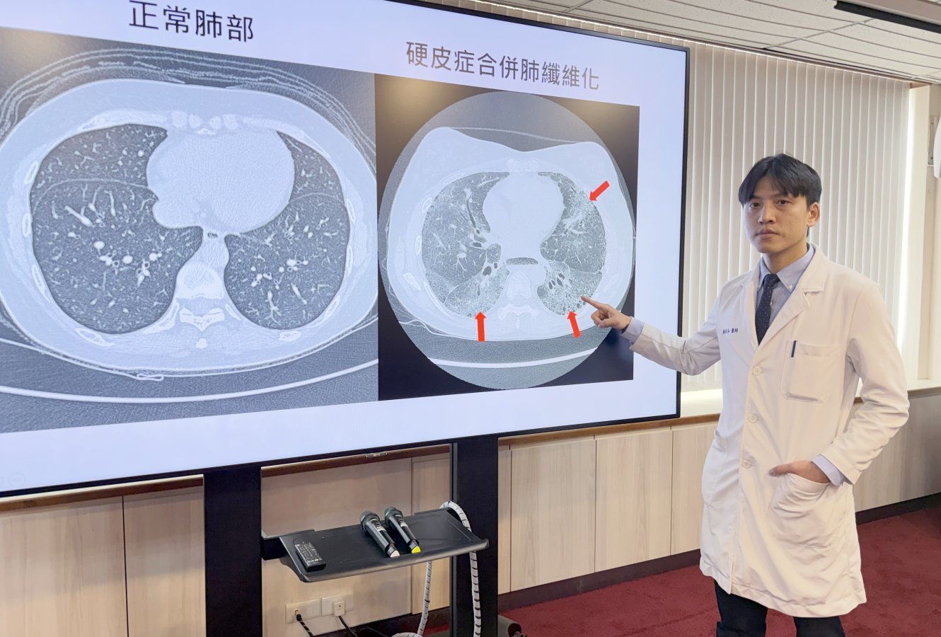 臺中榮總過敏免疫風濕科醫師顏在弘說明肺纖維化是全身性硬化症最嚴重的併發症中