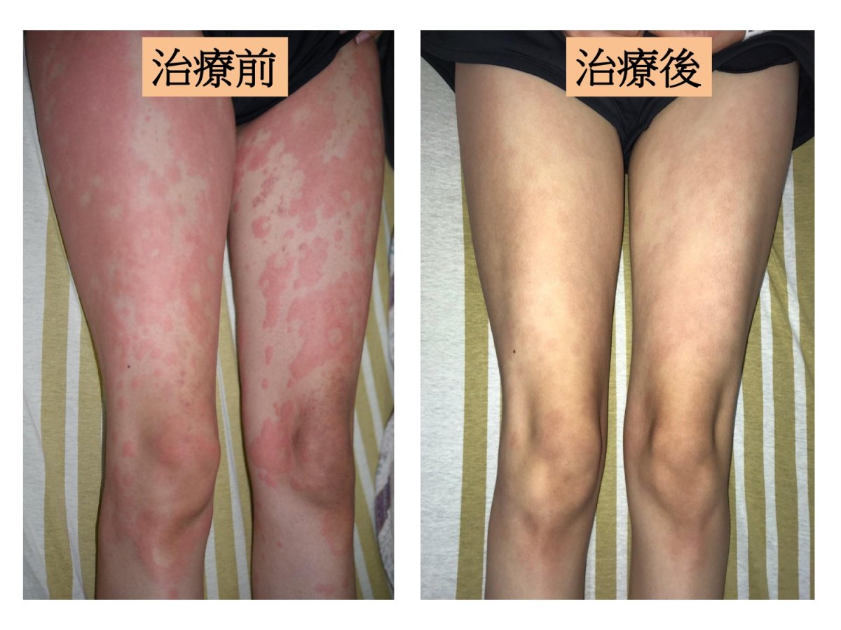 病患治療前左圖身體多處蕁麻疹樣皮疹伴隨搔癢燒灼感治療一週後右圖紅