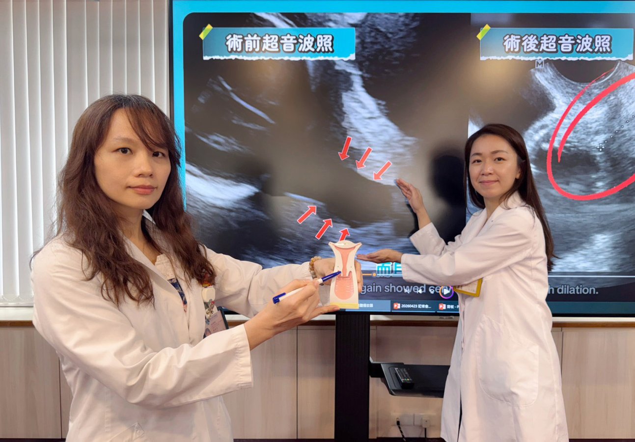臺中榮總婦女醫學部高危險妊娠科主任陳雅芳左指出子宮頸縮短及擴張位置醫師林俐伶