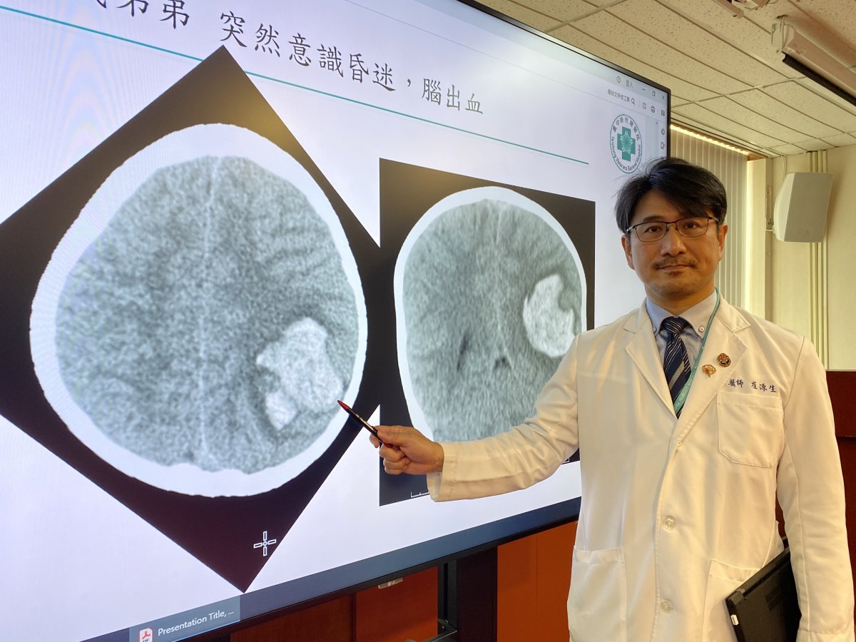 22臺中榮總神經醫學中心介入性腦血管外科主任崔源生說明4歲男童到院時腦動靜脈畸形合