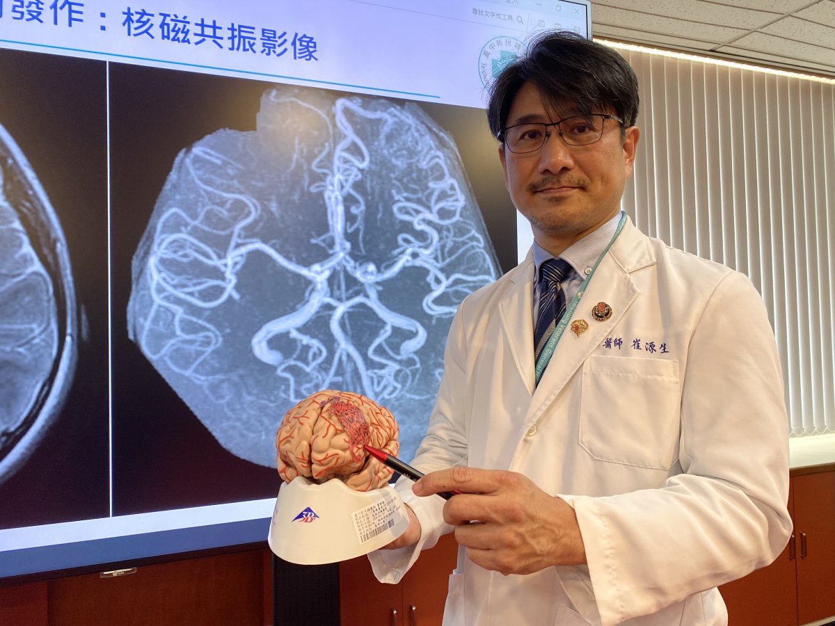 33333中榮總神經醫學中心介入性腦血管外科主任崔源生解釋劉小妹的腦動靜脈畸形在左額葉