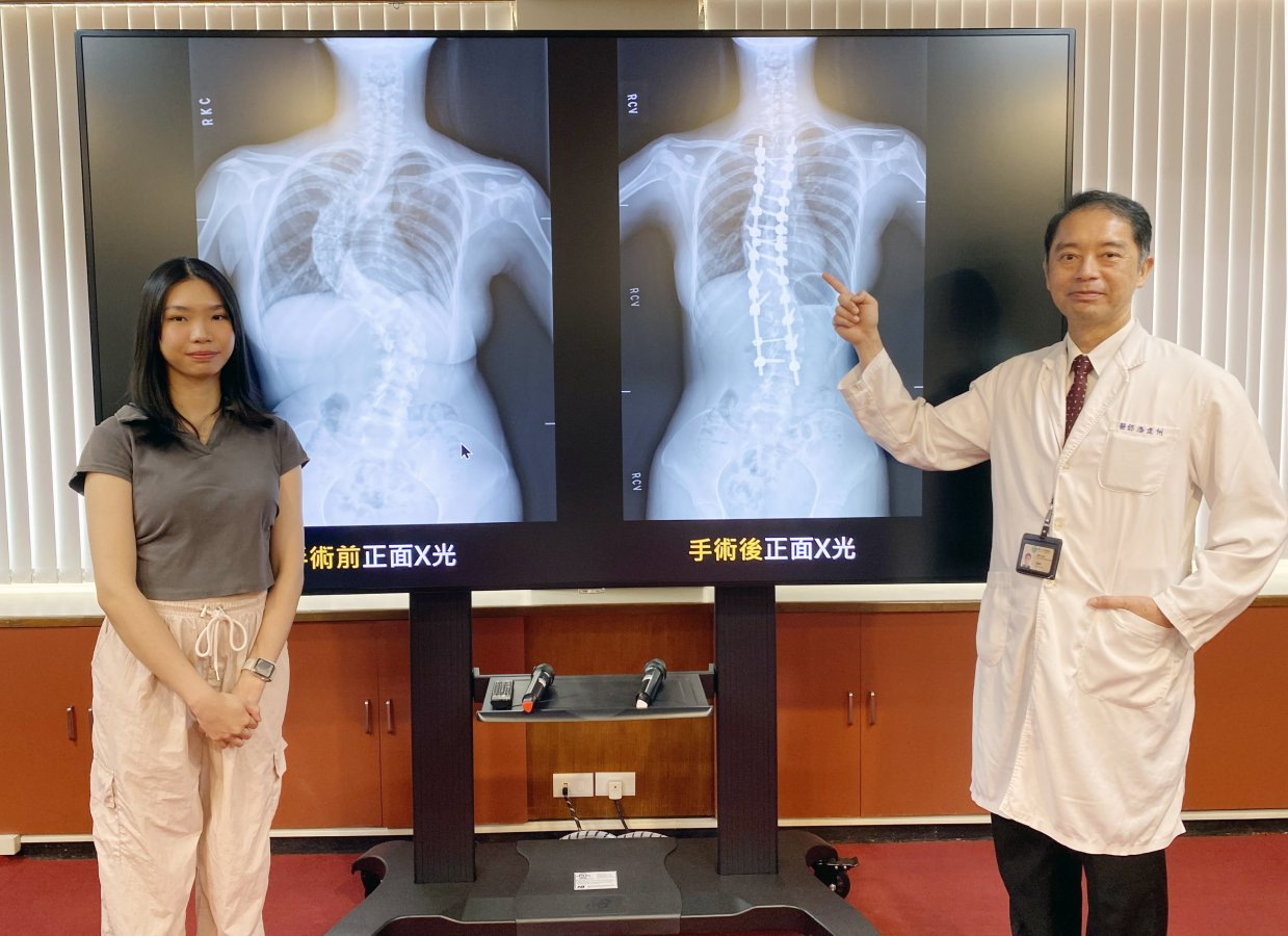 4黃同學左脊椎側彎達90度臺中榮總骨科部脊椎外科主任潘建州右為她進行脊椎機械手