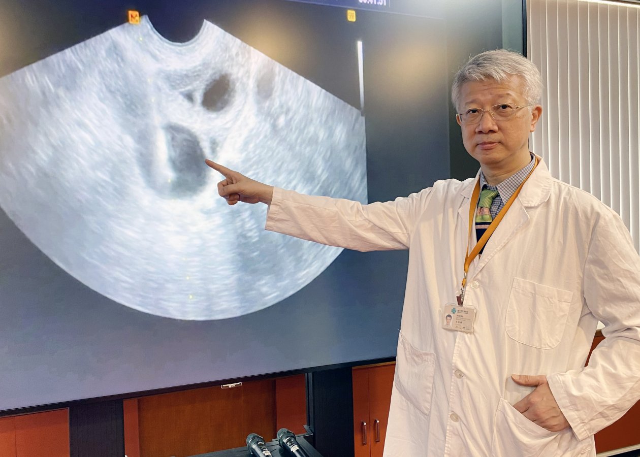 3臺中榮總婦女醫學部生殖內分泌不孕症科主任易瑜嶠說明透過手術取卵能有效幫助民眾