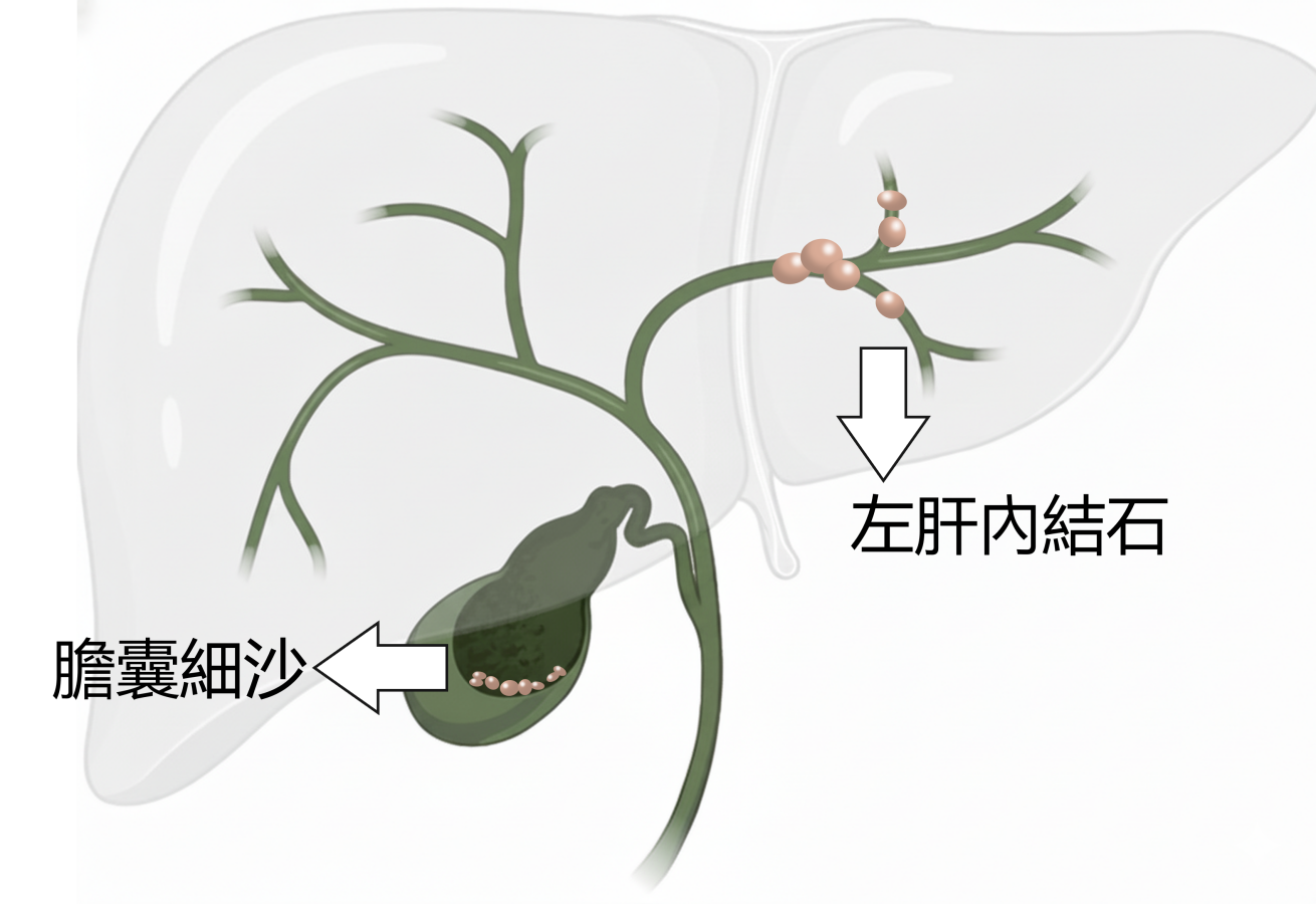 結石位置示意圖